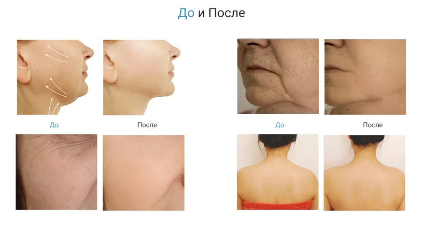4EMS Facial Lifting Treatment