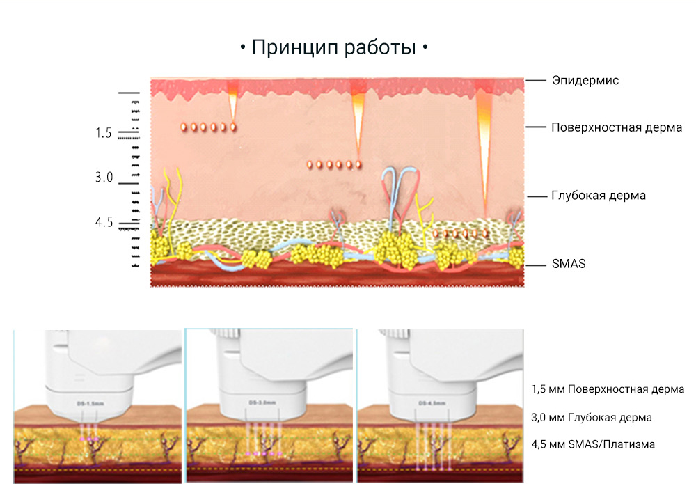5D Hifu