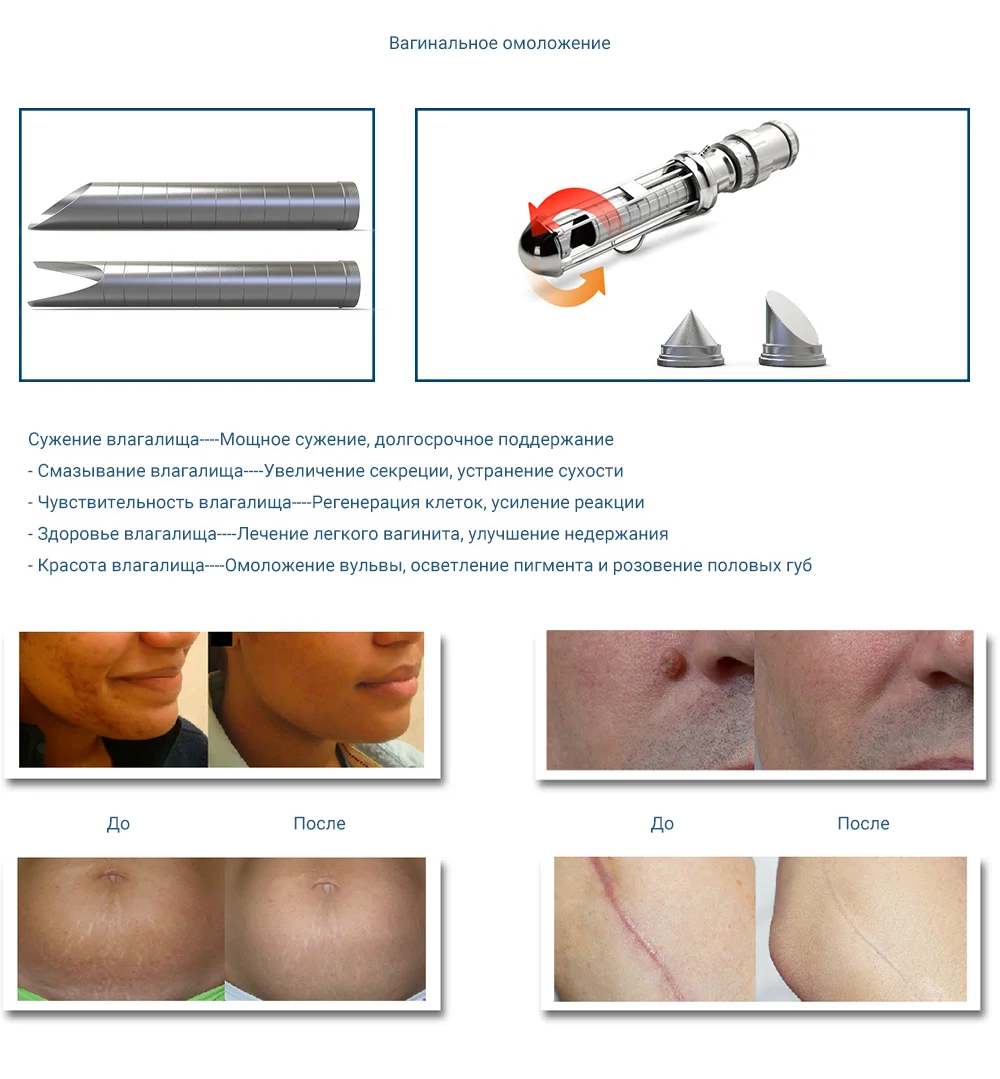 CO2-Laser-Resurfacing-5