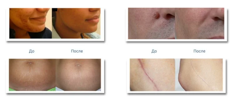 CO2 Laser Resurfacing Revitalize Your Skin in One Treatment2