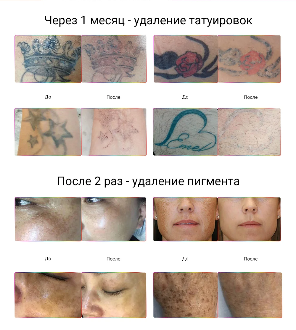 EL900 Пикосекундный лазерный аппарат для удаления пигментации 两次效果图