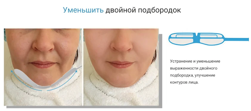 rf лифтинг лица - Уменьшает второй подбородок.
