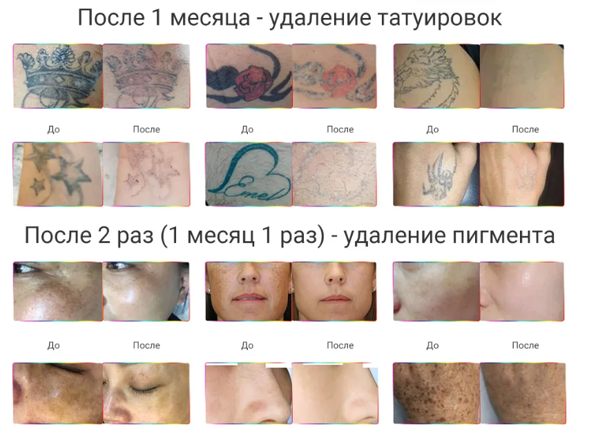 Лазерное удаление татуировок - сравнение результатов