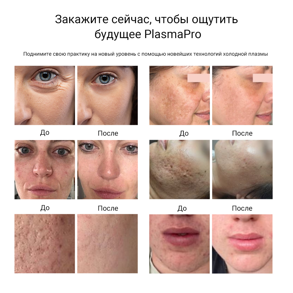 ​​Гипер Термо-Холодная Плазменная Фьюжн-Машина для Лифтинга Лица – Устройство для Ухода за Кожей​