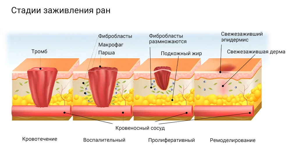 Плазменной Фьюжн заключается в её неинвазивности