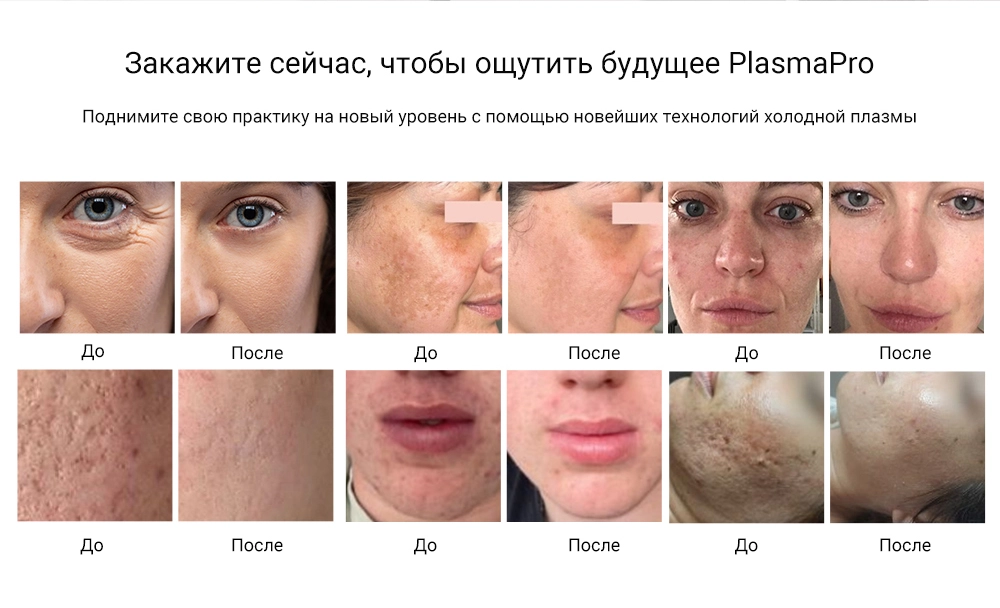 Гипер Термо-Холодная Плазменная Фьюжн-Машина для Лифтинга Лица