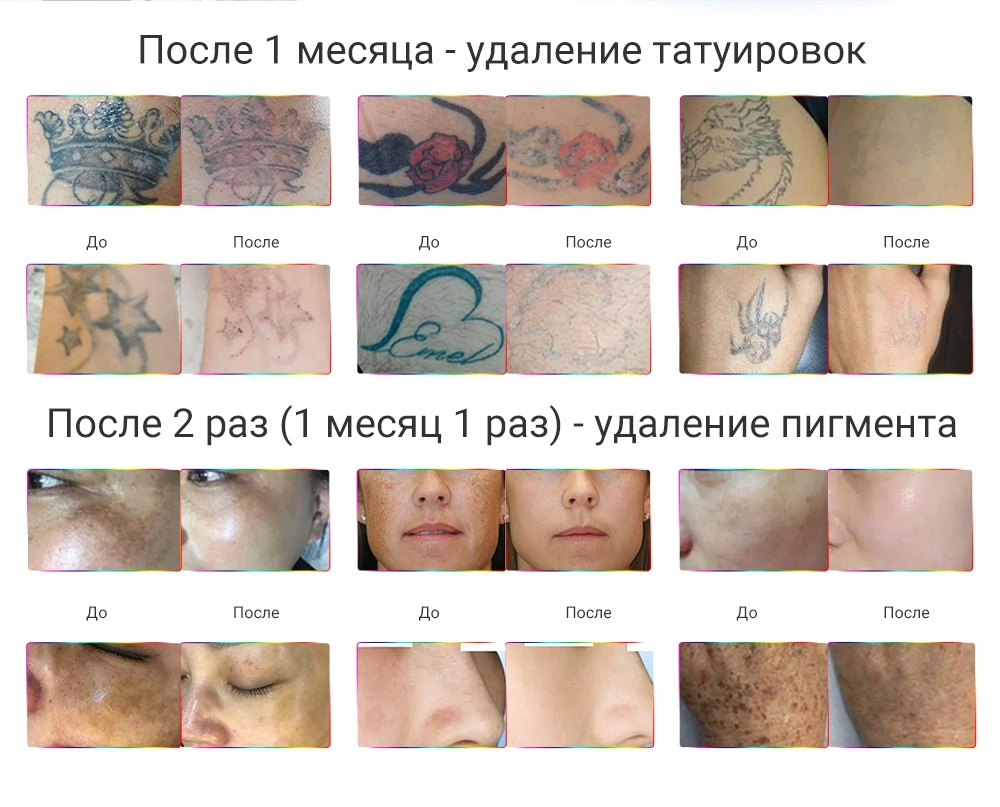 Результаты удаления татуировок и пигмента