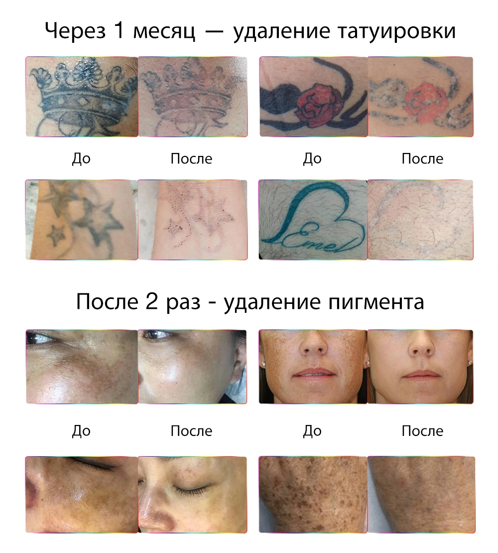 Аппараты для пикосекундного лазерного удаления татуировок до и после