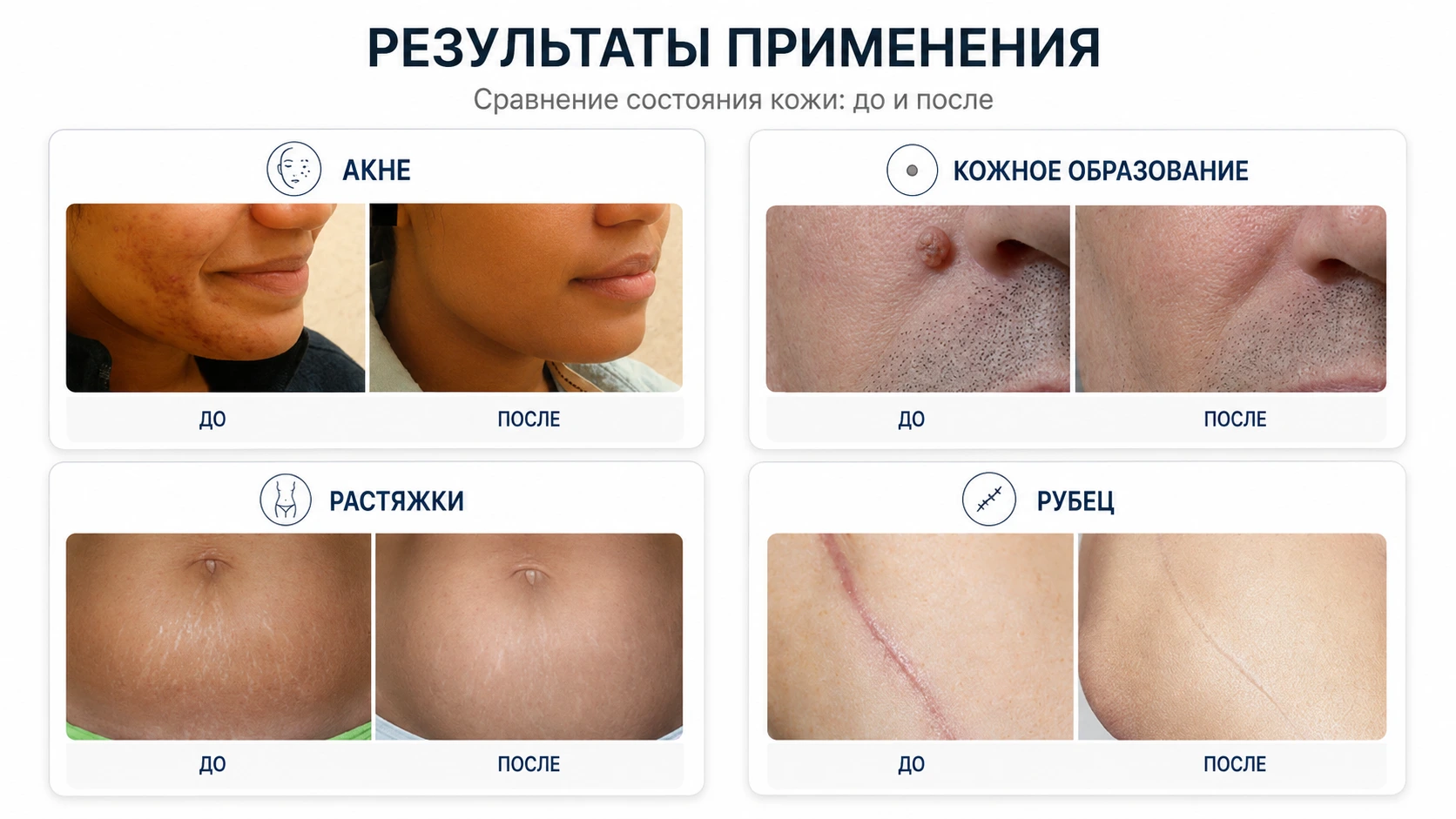 Результаты до и после процедур фракционным СО₂-лазером для кожи, рубцов и растяжек