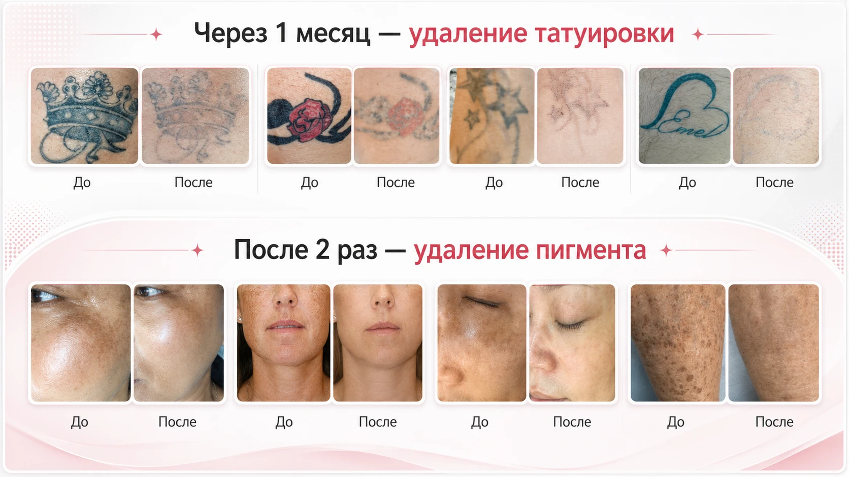 Результаты удаления татуировок и пигментации до и после