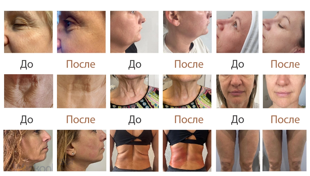 Результаты до и после процедур ХИФУ