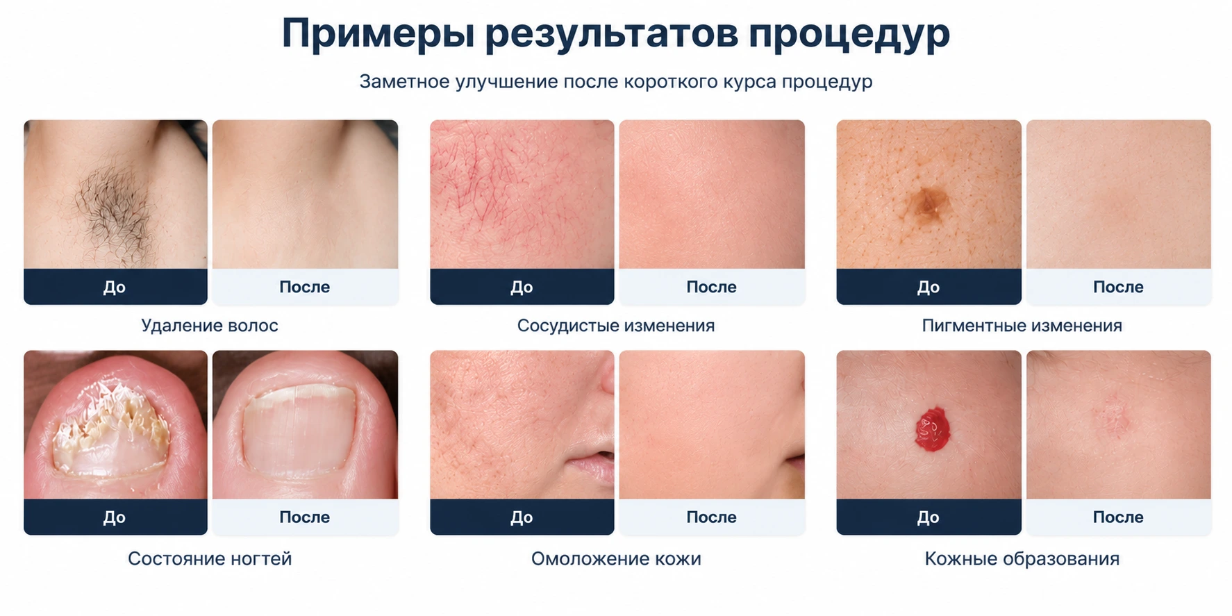 Официальные примеры применения EL200B для удаления волос, пигментных и сосудистых процедур